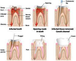 Root canal treatments Ormeau