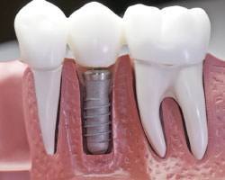 Dental implants Ormeau