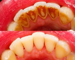 Preventative dental care in Ormeau