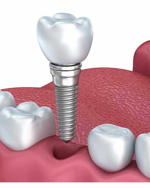 Dental implant & crowns